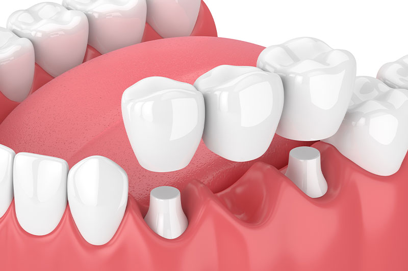 Dental Bridges in Radnor