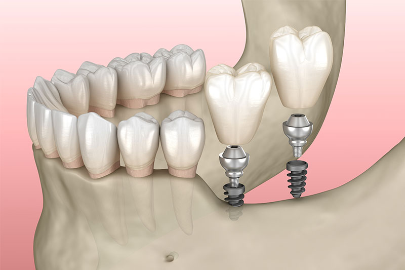 Dental Implant Restoration in Radnor