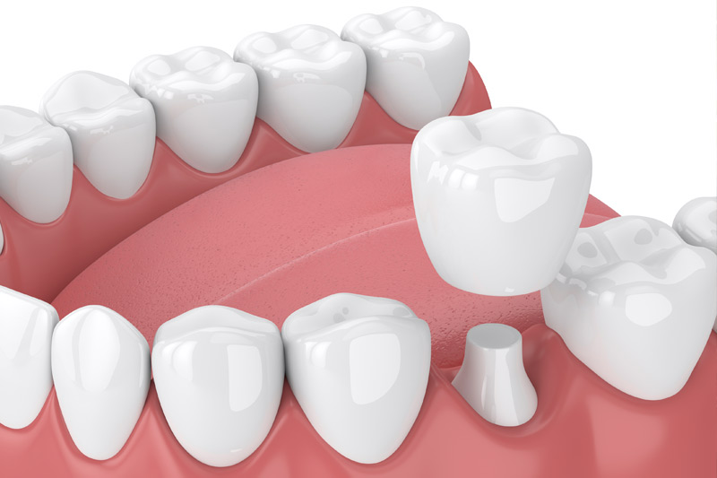 Dental Crowns in Radnor
