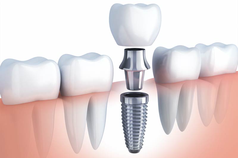 Implants Dentist in Radnor