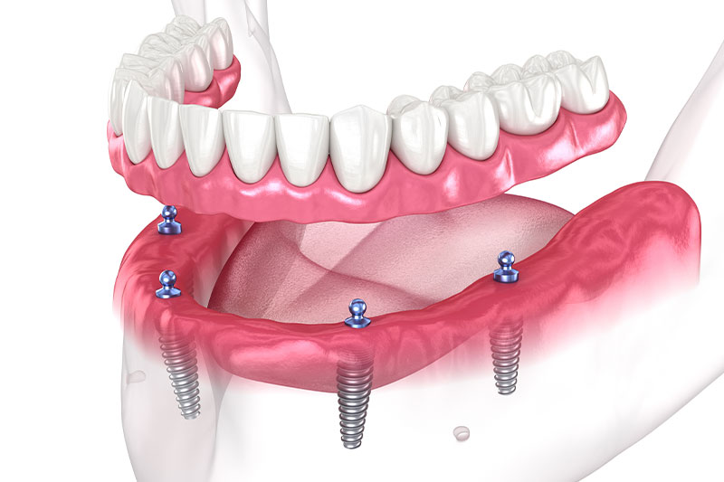 Overdentures in Radnor