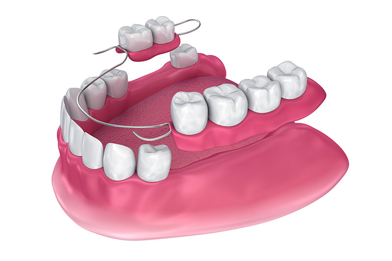 Partial Dentures in Radnor